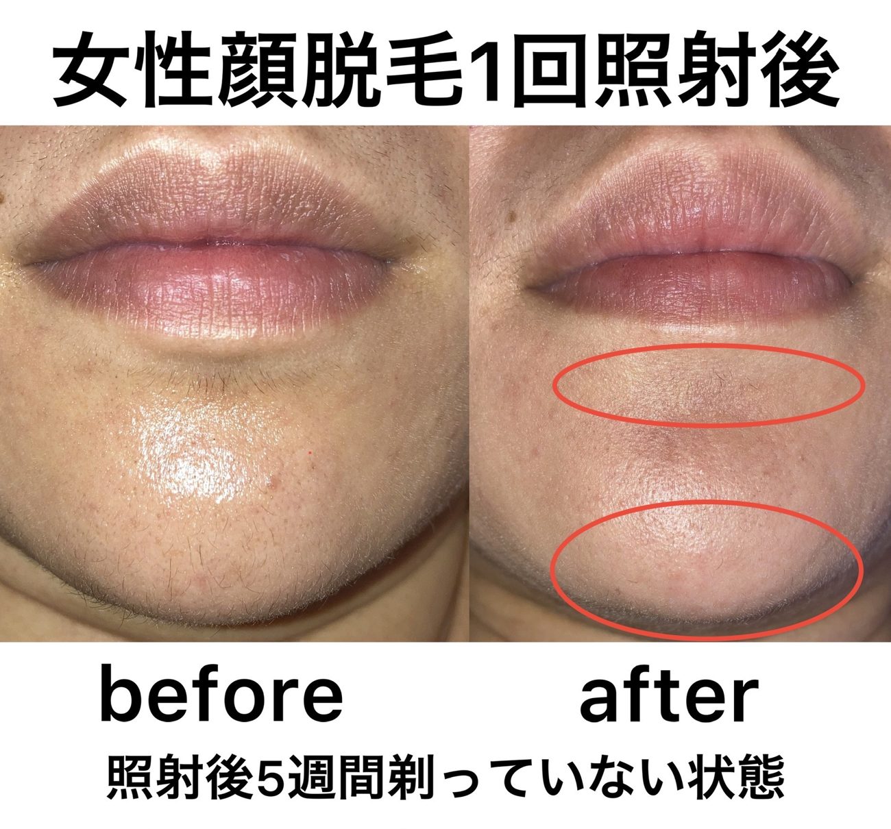 女性顔脱毛の症例